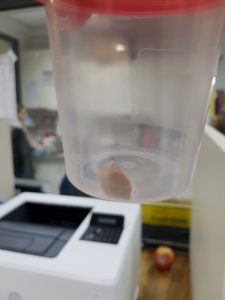 האבן שהוצאה מכף ידו של רוכב האופניים (צילום: דוברות טרם)