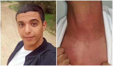 אופיר חממי וסימני החניקה סימני החניקה (צילום: פרטי)