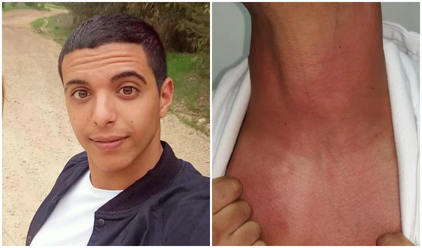 אופיר חממי וסימני החניקה סימני החניקה (צילום: פרטי)